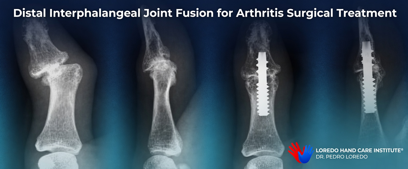 Distal interphalangeal (DIP) joint fusion X-ray sequence for arthritis surgical treatment showing the arthritic joint before surgery and after fusion with a small intramedullary screw maintaining bone-on-bone contact for solid healing. Created for Loredo Hand Care Institute by Dr. Pedro Loredo.