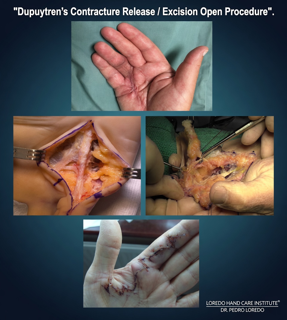 Open palmar fasciectomy surgical procedure showing zigzag (Brunner) incision and surgical excision of the diseased palmar fascia cord with careful preservation of the digital nerves and arteries.