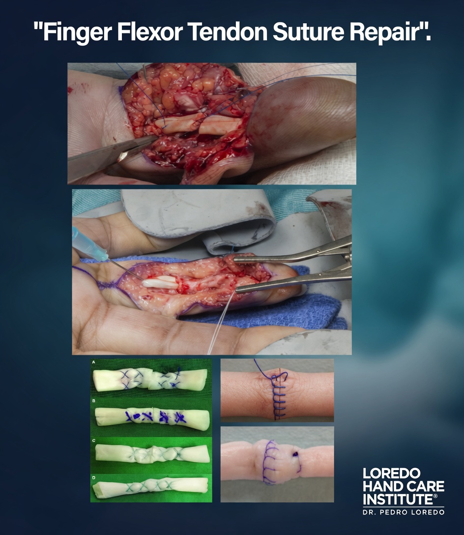 Flexor tendon suture repair technique showing a multi-strand core suture plus a circumferential epitendinous suture between the two tendon ends, providing the strength needed for early controlled motion.