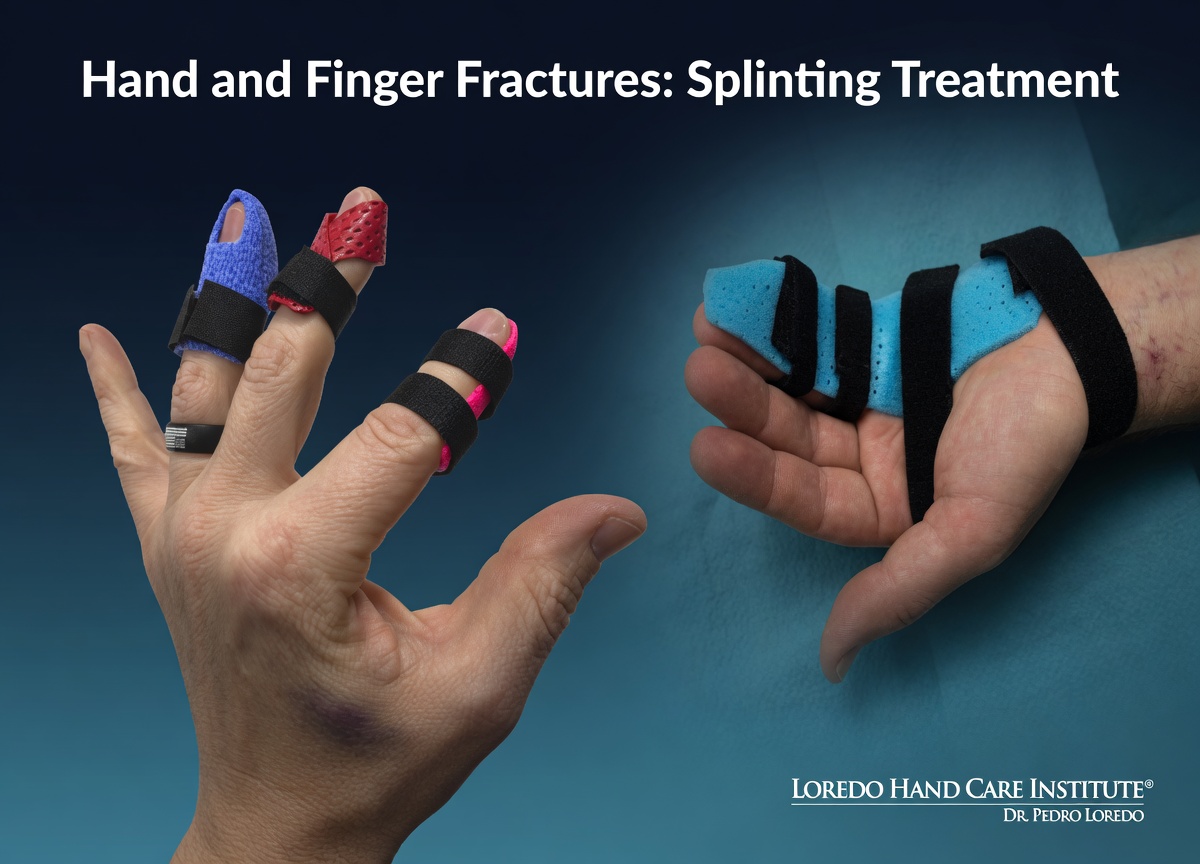 Splinting and casting for stable hand and finger fractures showing a custom hand-based splint, a forearm-based cast, and buddy-taping of adjacent fingers for stable phalanx fractures.