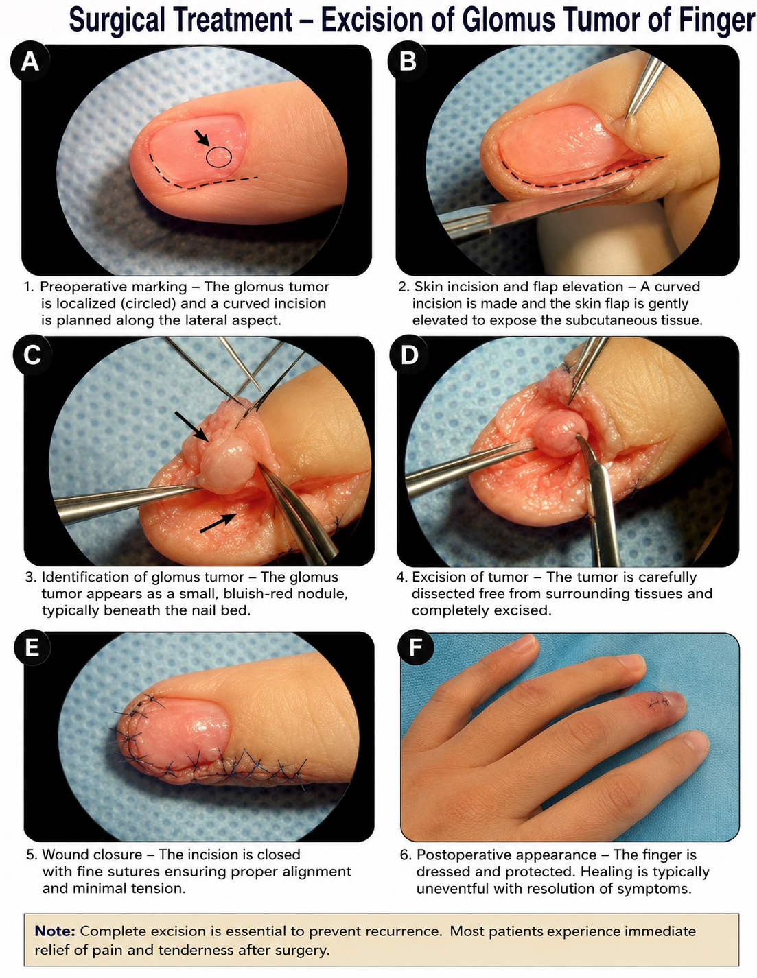 Surgical excision of a glomus tumor from a finger through a transungual approach
