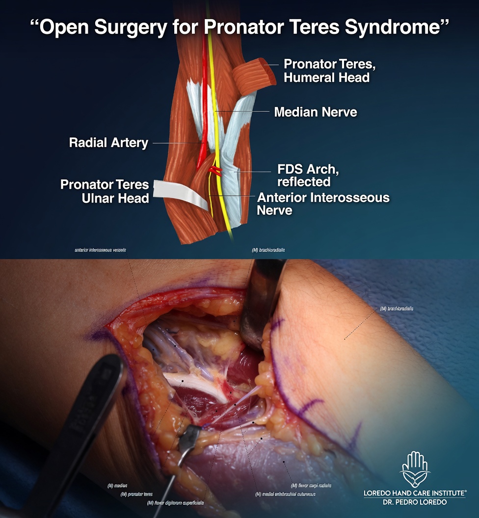 Open surgical decompression of the median nerve in the proximal forearm for pronator teres syndrome, showing exposure of the median nerve and sequential release of the lacertus fibrosus, the pronator teres heads, and the proximal FDS arch