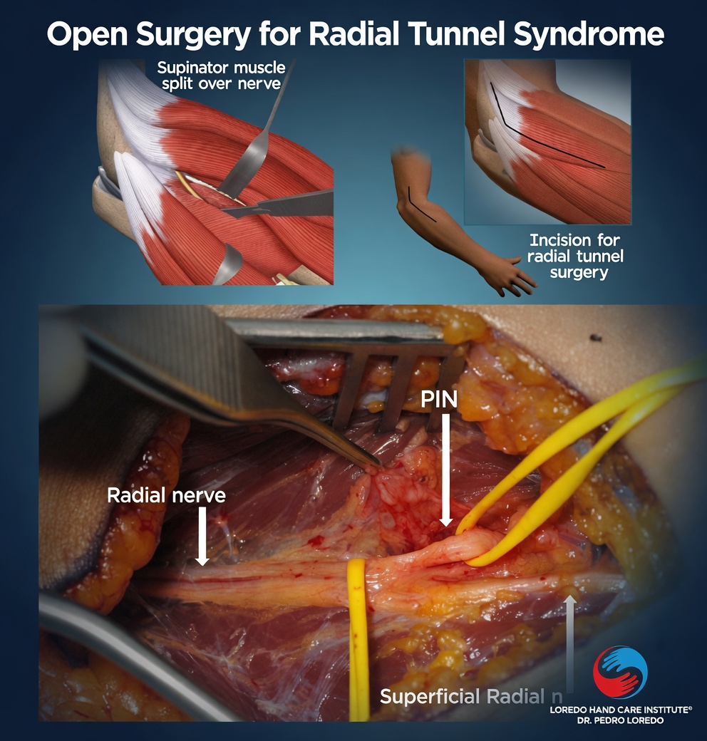 Open surgical decompression of the posterior interosseous nerve in radial tunnel syndrome showing release of all five potential compression sites along the tunnel including the Arcade of Frohse
