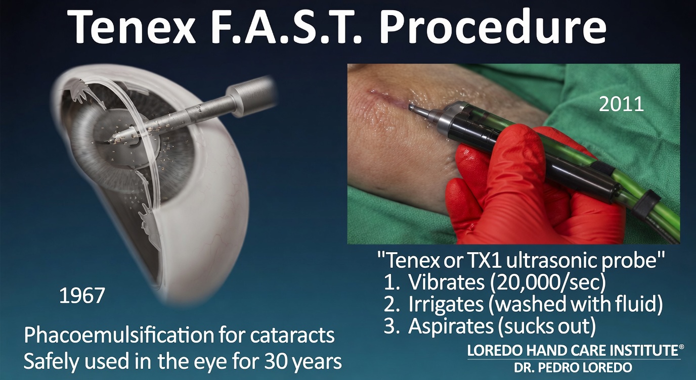 Tenex FAST percutaneous tenotomy for tennis elbow, second illustration showing ultrasonic debridement of angiofibroblastic tendinosis at the lateral epicondyle