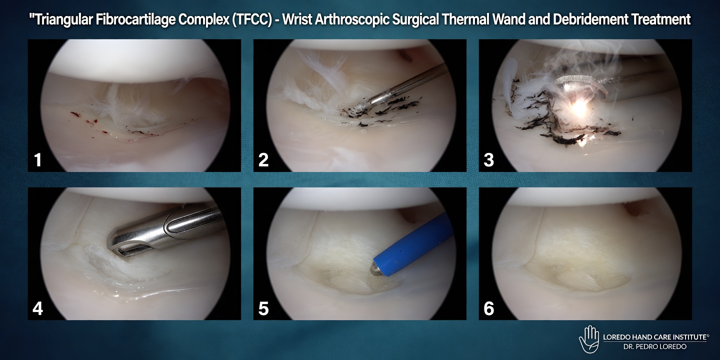 Wrist arthroscopy with thermal wand and motorized shaver performing TFCC debridement of a central Palmer 1A tear, smoothing the torn central portion while preserving the peripheral attachment.