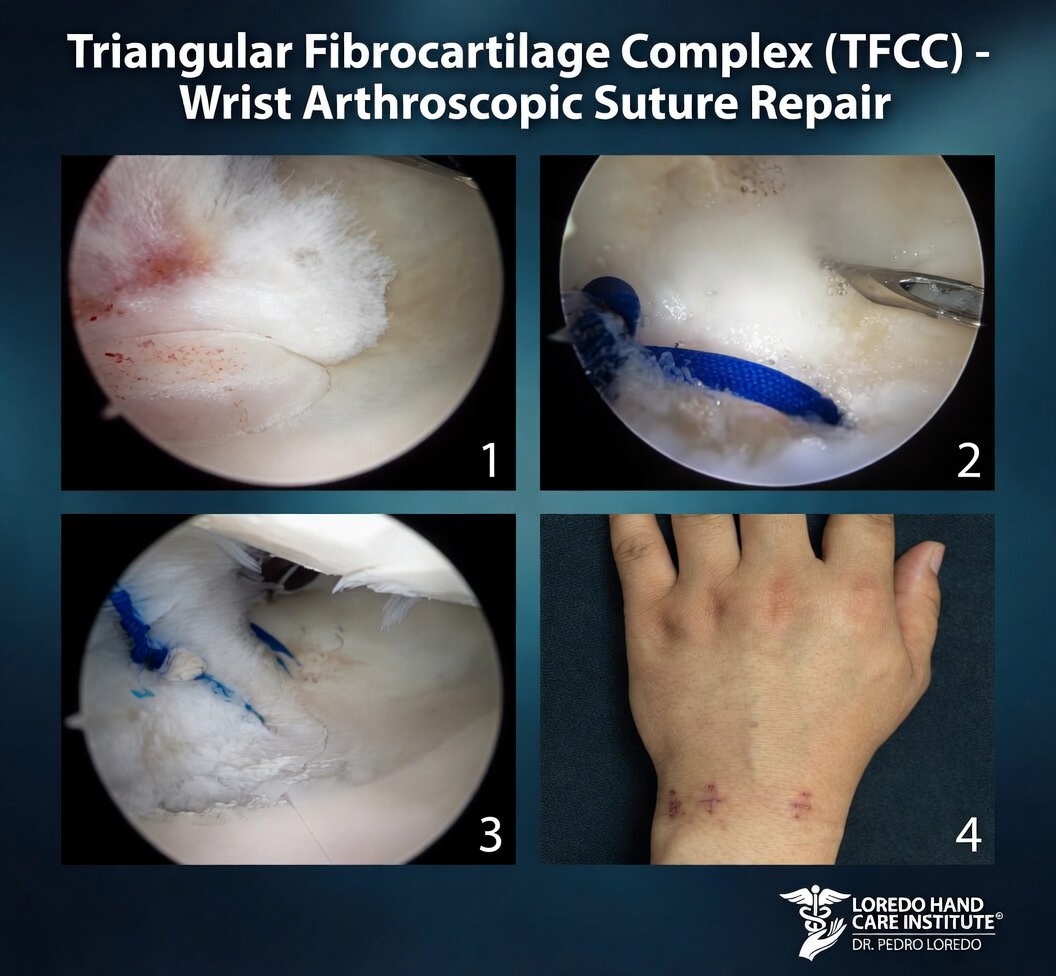 Arthroscopic TFCC suture repair showing outside-in suture passers placing nonabsorbable sutures across the torn peripheral TFCC and tying them over the capsule to restore foveal attachment and DRUJ stability.